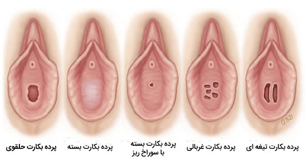 عکس انواع پرده بکارت